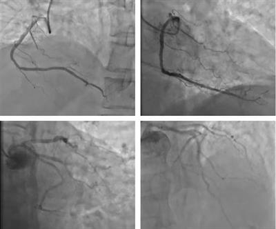 Case report: Regression after low-dose glucocorticoid therapy in a case of acute immune myocarditis induced by anti-PD-1 therapy for NSCLC